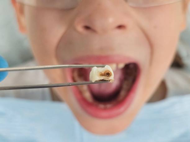 Best Emergency Wisdom Teeth Removal in Shenandoah Junction, WV